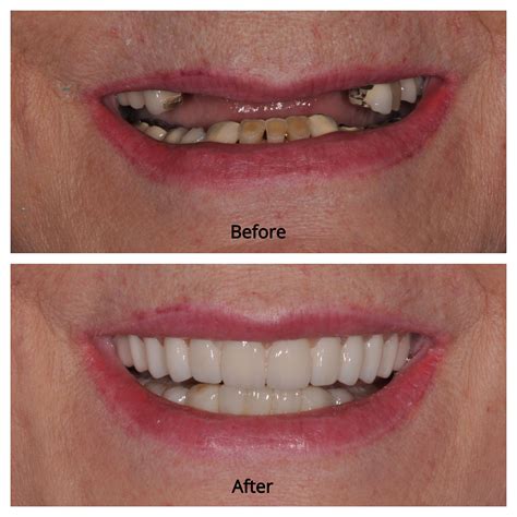 full mouth dental implants oatfield or  Find out if you're a 